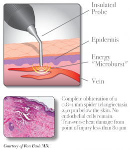 Microburst Technology