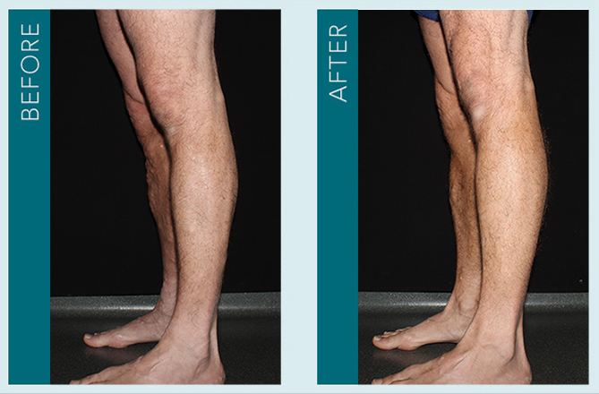 Vein Treatment - Before and After