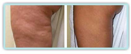 Cellulite Reduction