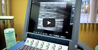 Duplex Ultrasound Removes Varicose Veins