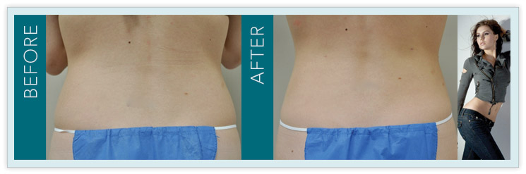 Laser-Assisted Liposuction