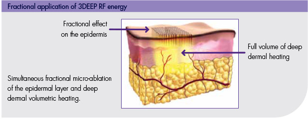 3DEEP® Fractional Skin Resurfacing