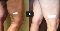 Varicose Vein Treatment and Blood Circulation