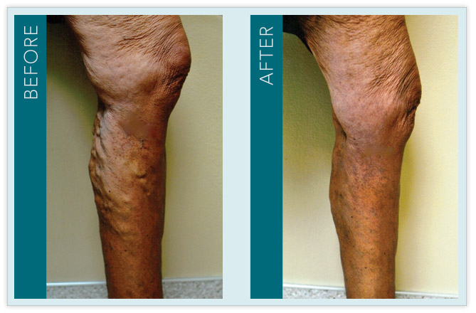 Vein Treatment - Before and After