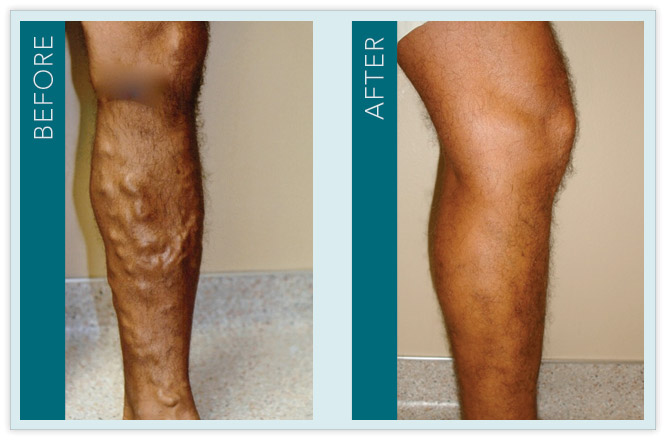 Vein Treatment - Before and After