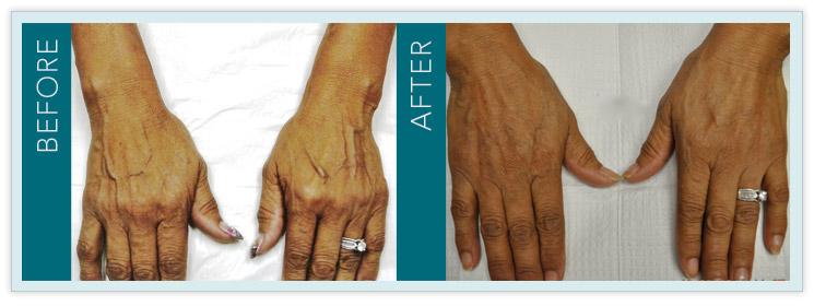 Vein Treatment - Before and After