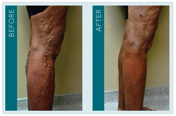 Vein Treatment - Before and After