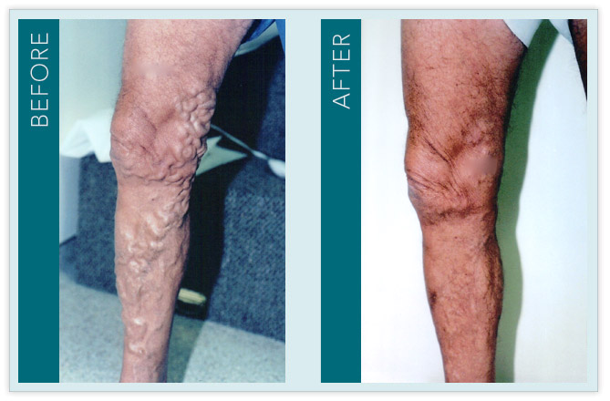 Vein Treatment - Before and After