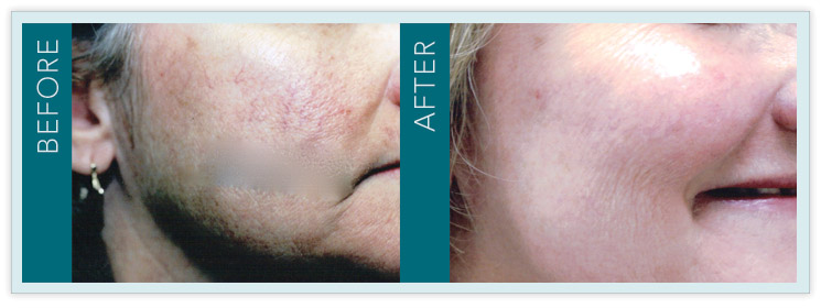 Vein Treatment - Before and After