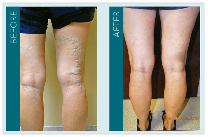 Vein Treatment - Before and After