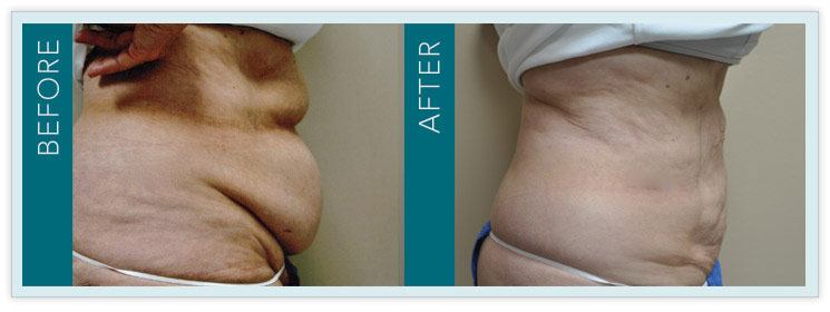 Laser-Lipo Before and After