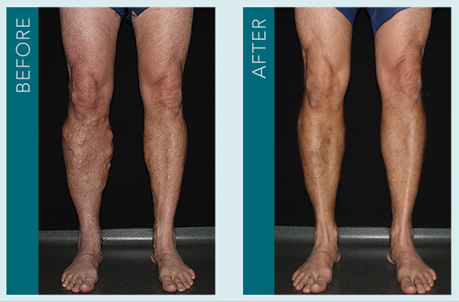 Vein Treatment - Before and After