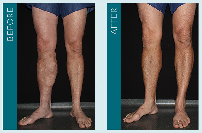 Vein Treatment - Before and After