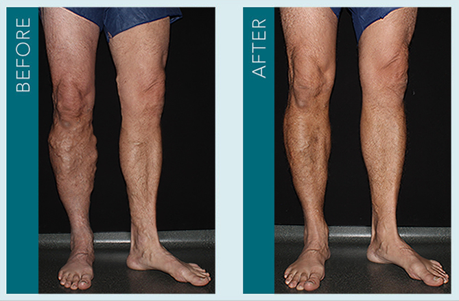 Vein Treatment - Before and After