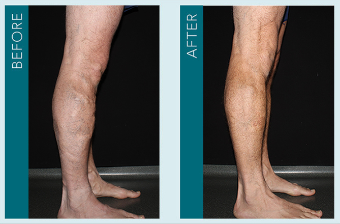 Vein Treatment - Before and After