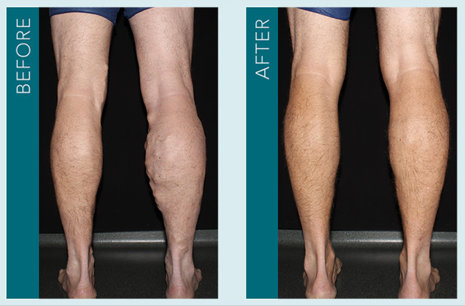 Vein Treatment - Before and After