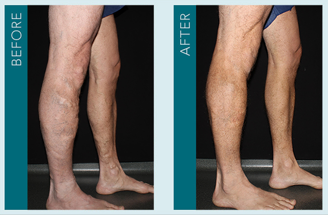 Vein Treatment - Before and After