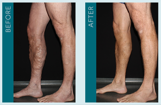 Vein Treatment - Before and After